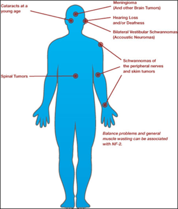 {Image: A computer drawing of the human body shape colored blue.  There are words with arrows pointing to different parts of the body (Cataracts at a young age, Meningioma (and other Brain Tumors), Hearing Loss and/or Deafness, Bilateral Vestibular Schwannomas (Acoustic Neuromas), Schwannomas of the peripheral nerves and skin tumors, Balance problems and general muscle wasting can be associated with NF-2).} 