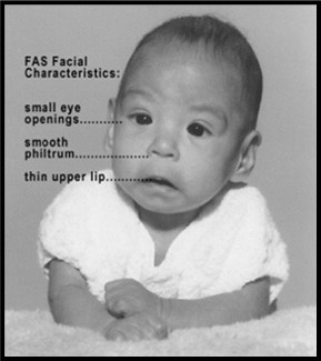 Image: A black and white picture of a newborn baby looking straight ahead.  There are words on the picture identifying FAS Facial Characteristics: small eye openings, smooth philtrum, and thin upper lip.