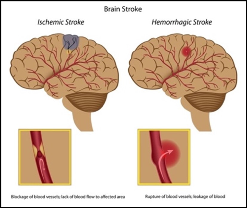 Image: Two computer drawn images of a brain with irregular red lines to resemble blood vessels.  The image on the left has a gray spot on the top, center of the brain and the words “Ischemic Stroke” written above.  Beneath there is a box with a zoomed image of a red blood vessel with a darker red spot in the middle and a yellow hour-glass shape above it to indicate a blockage in the vessel.  There is an arrow pointing up to the dark red spot and then the arrow makes a downward U-turn to indicate the blood is blocked from going further.  Text says “Blockage of blood vessels; lack of blood flow to affected area.”   The image on the right has a red spot in the middle of the brain and above the image are the words “Hemorrhagic Stroke.”  Beneath there is a box with a zoomed image of a red blood vessel with a swollen spot in the middle and a larger red circle around it.  There is an arrow pointing up and outward to the right of the vessel, indicating blood is exiting the vessel.  Text says “Rupture of blood vessels; leakage of blood.”