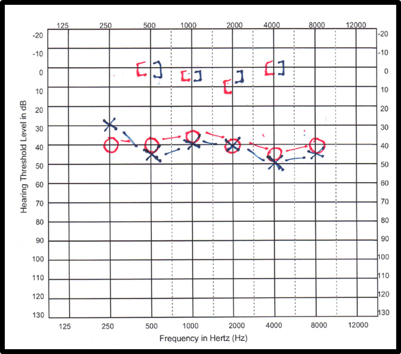 Audiogram with red right facing brackets and blue left facing brackets at 0. Blue X's and red circles from 250 to 8,000 Hz 